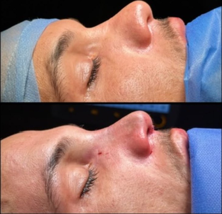 تجميل الأنف: قبل في الأعلى وبعد في الأسفل